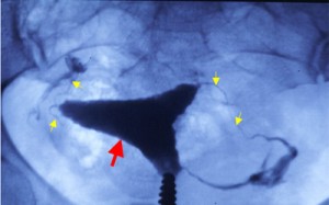 Hysterosalpingogram