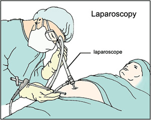 Laparoscopy