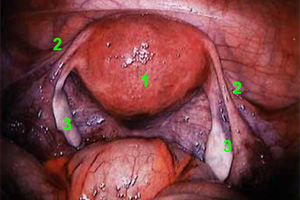 Laparoscopic Surgery - KL Fertility & Gynaecology Centre, Malaysia