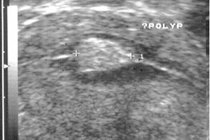 polyp within the endometrium