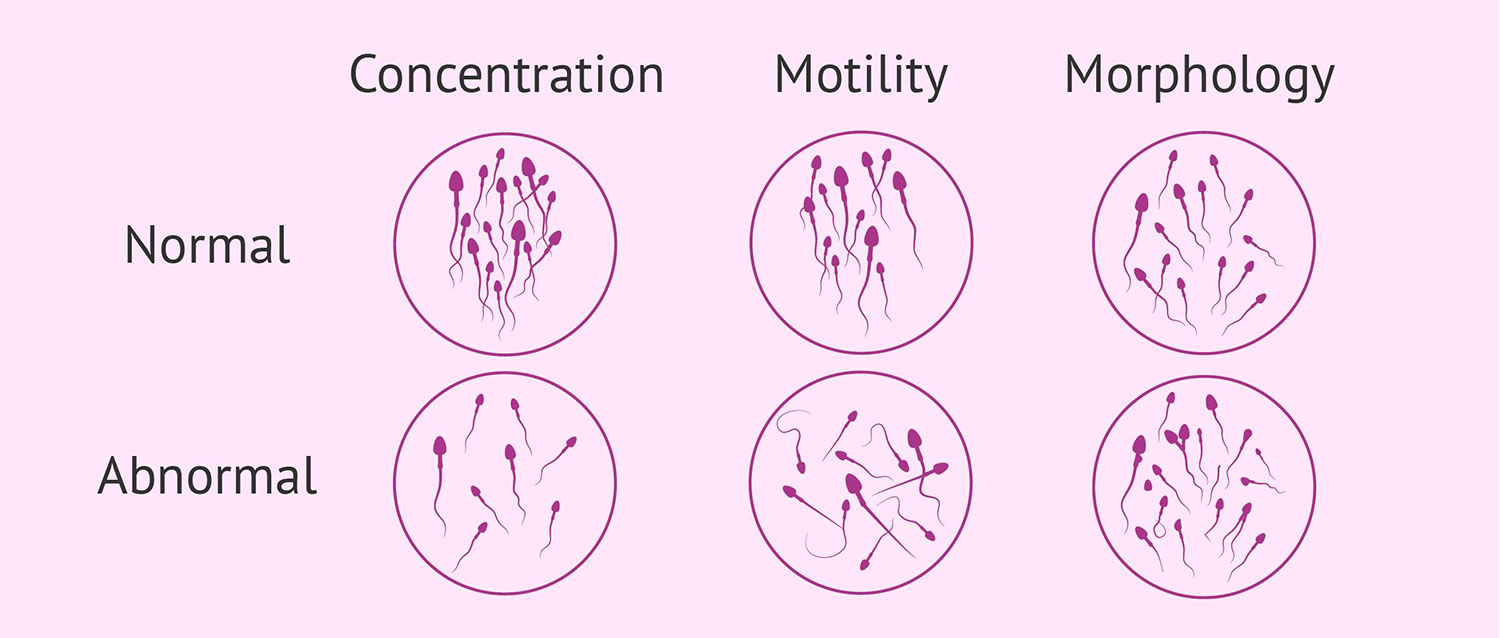 White blood cells - presence of white blood cells in semen specimen indicates signs of infection.