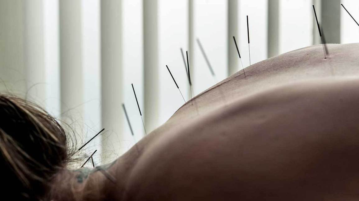 Try acupuncture