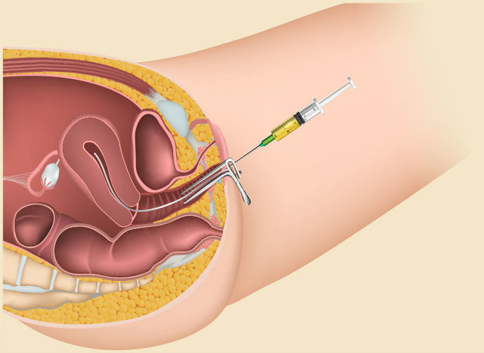 IUI: Intra-Uterine Insemination