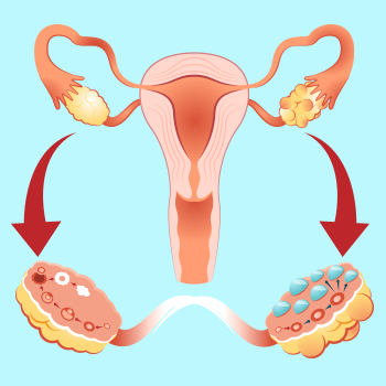 What is PCOS?