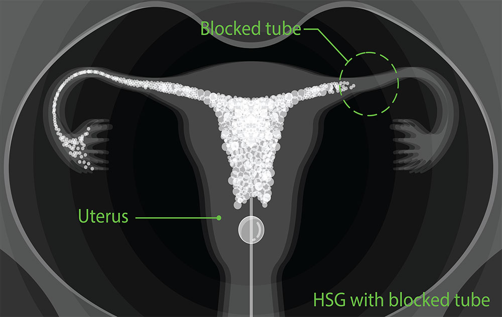 Hysterosalpingogram (HSG) blocked tube