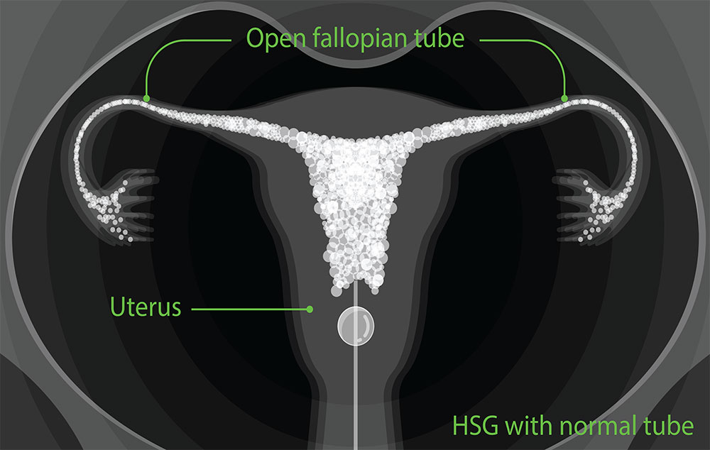 Hysterosalpingogram (HSG) normal tube