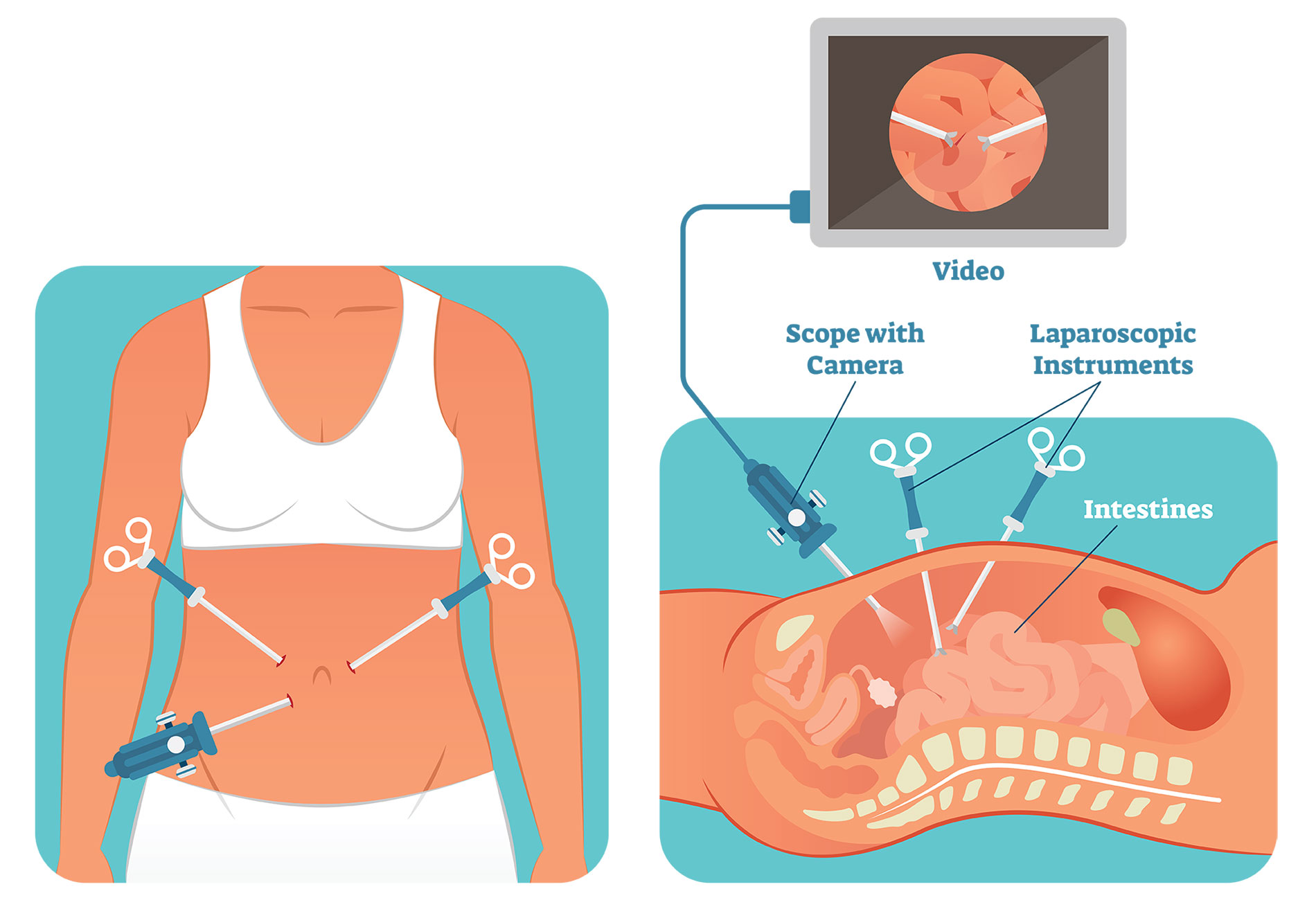 Laparoscopy