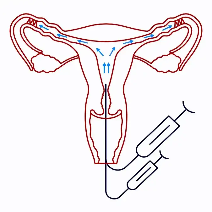 Blocked fallopian tube