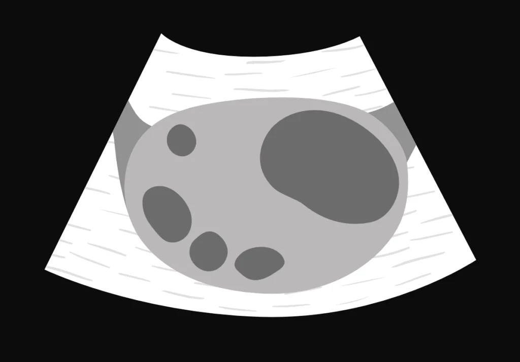 Dominant follicle in a normal ovary