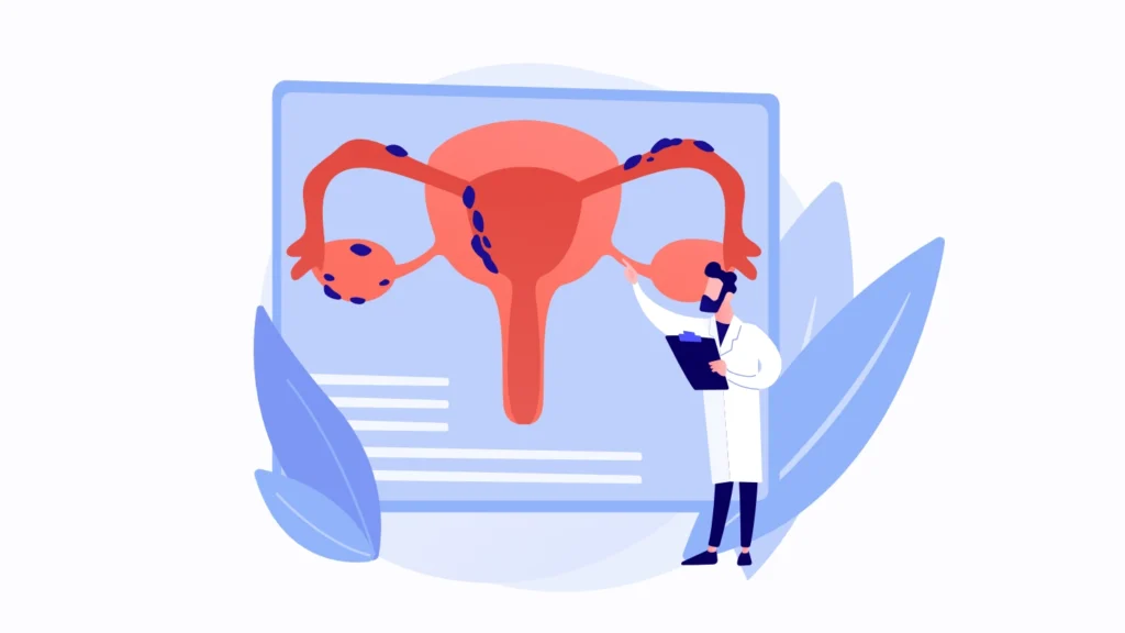 Endometriosis