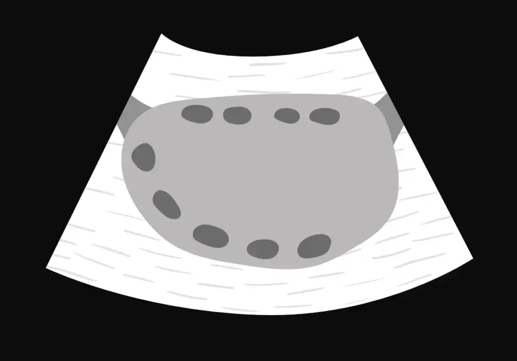 Follicles in normal ovary