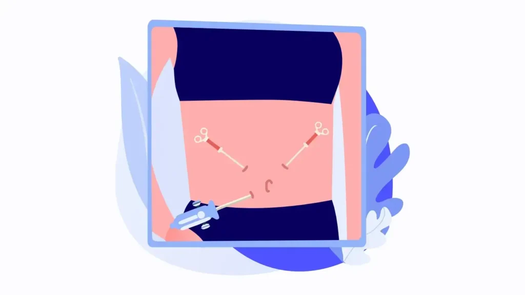 Laparoscopy