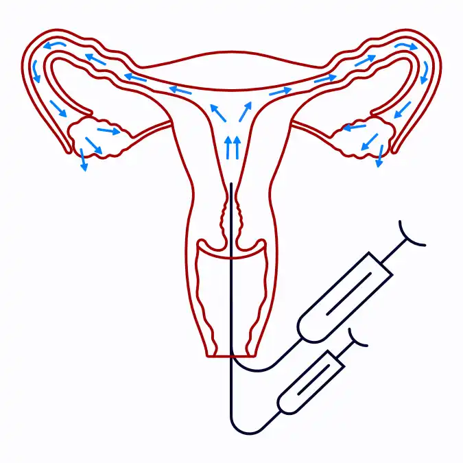 Patent fallopian Tube