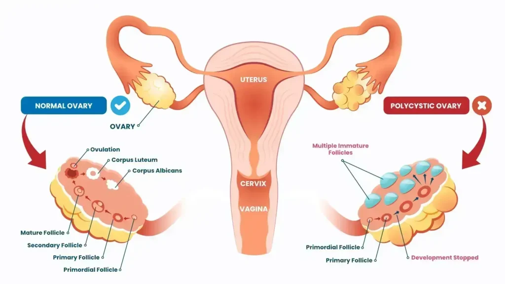 PCOS diagram