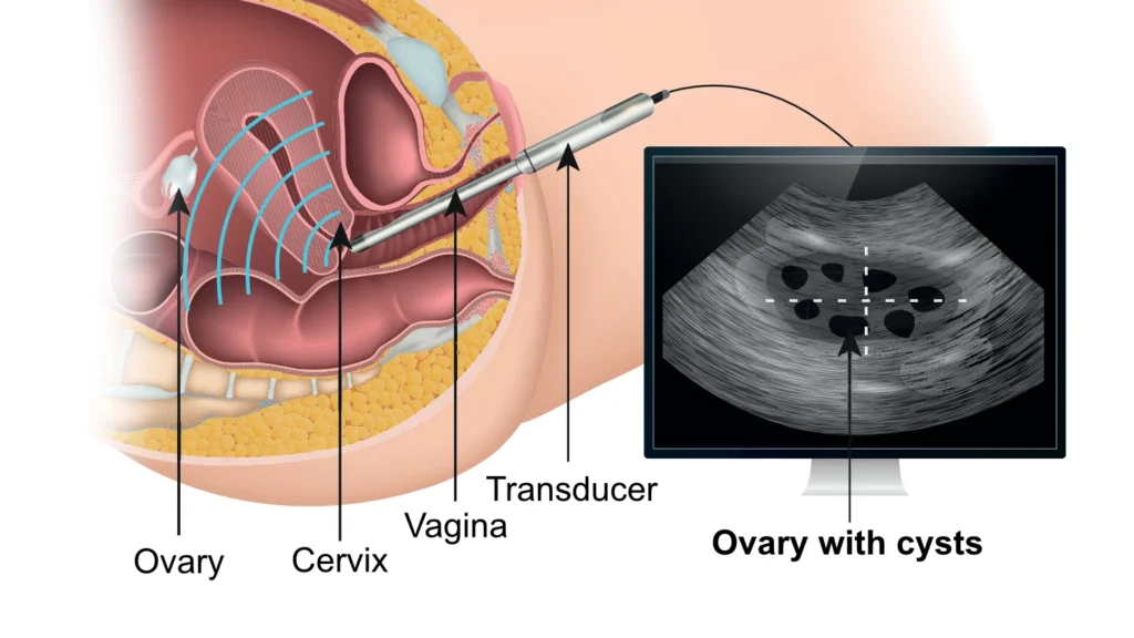 Illustration for performing transvaginal ultrasound