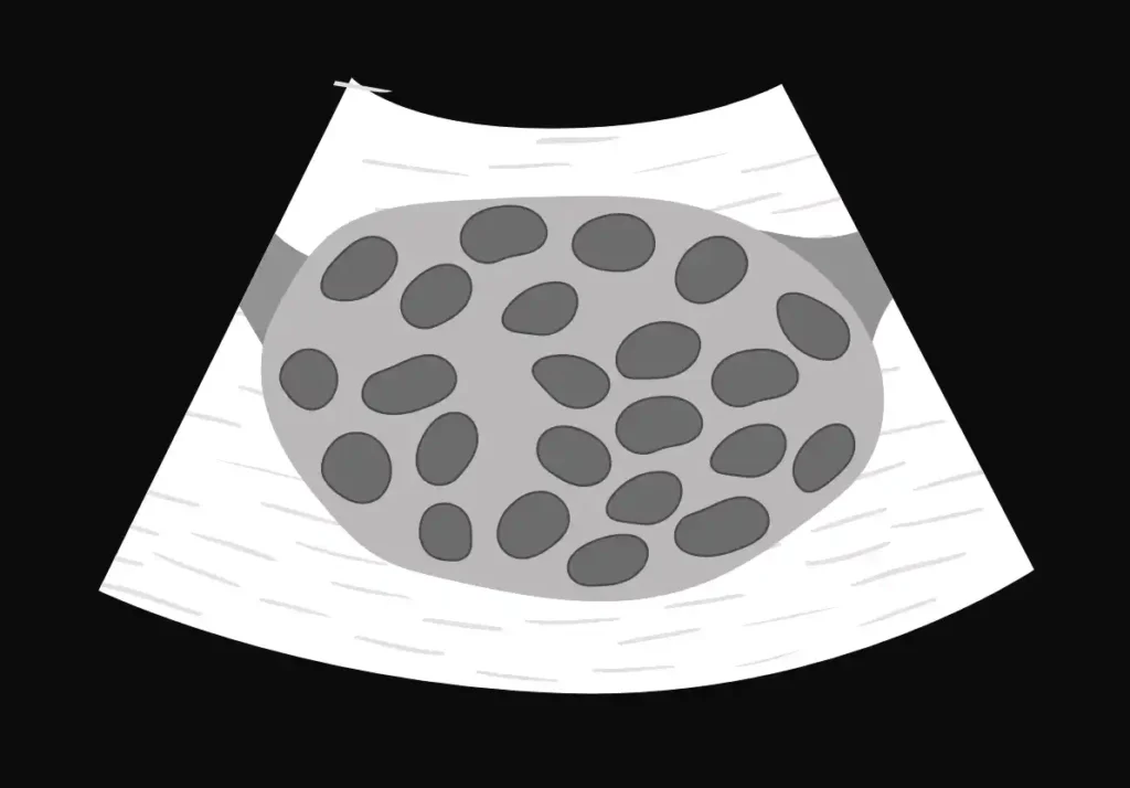 Polycystic ovary