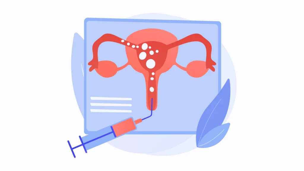 Saline Infusion Sonography (SIS)