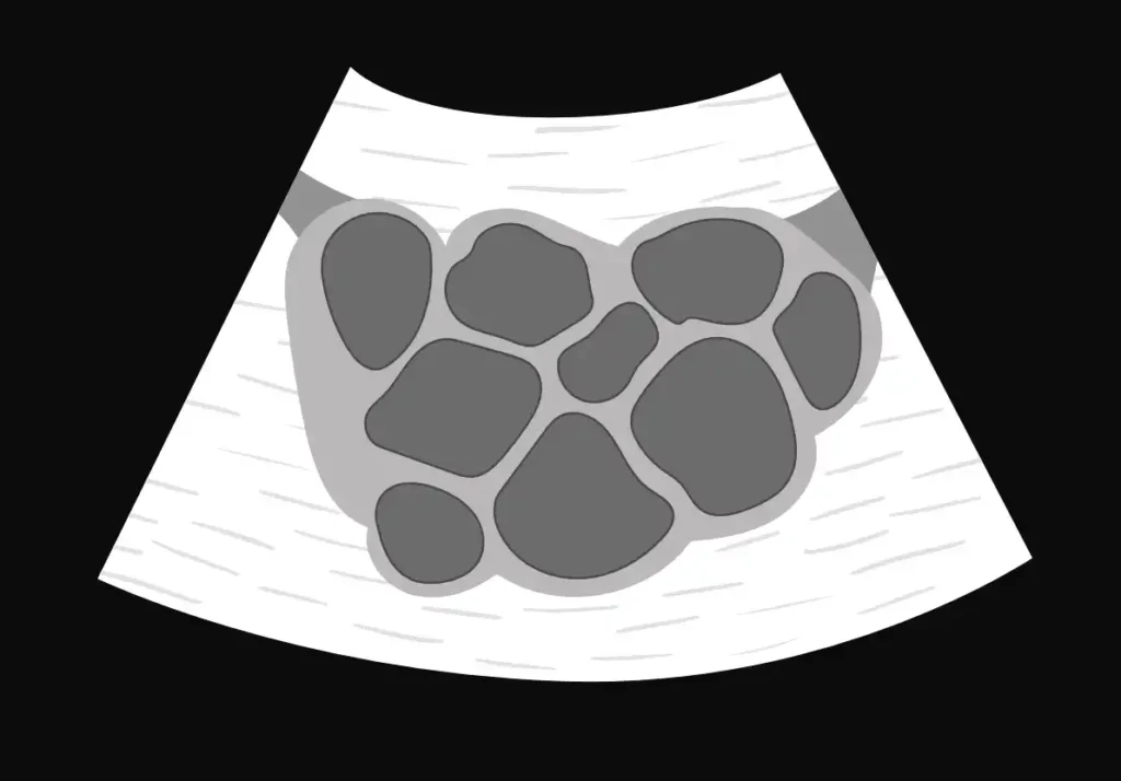 Stimulated ovary
