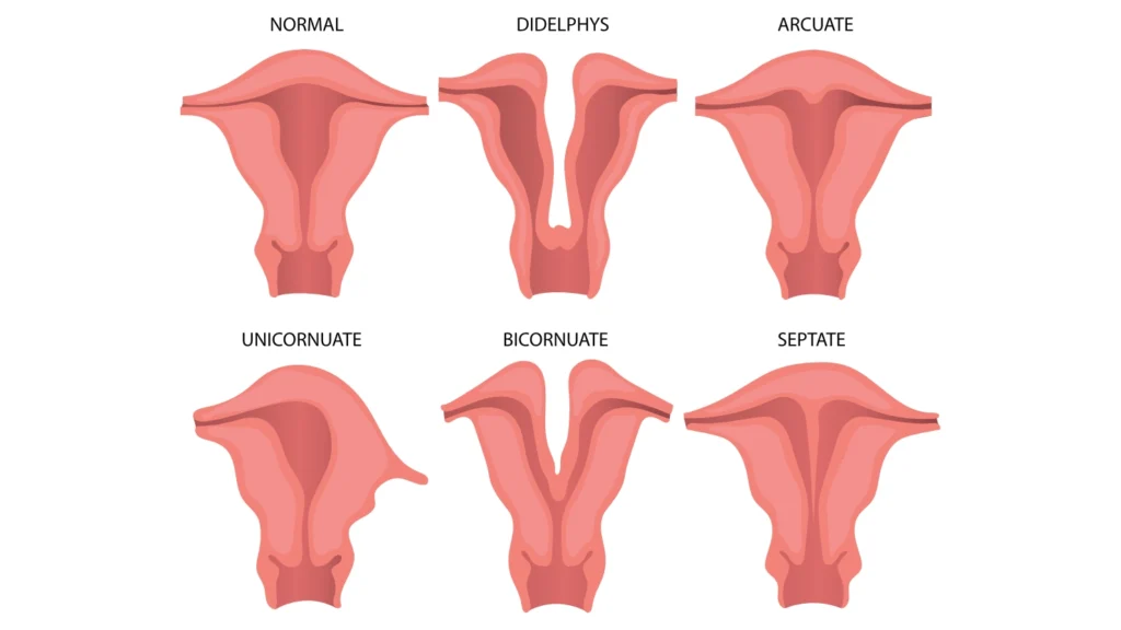 Congenital Uterine Anomalies (Müllerian Anomalies)