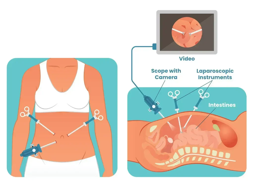 Laparoscopy diagram