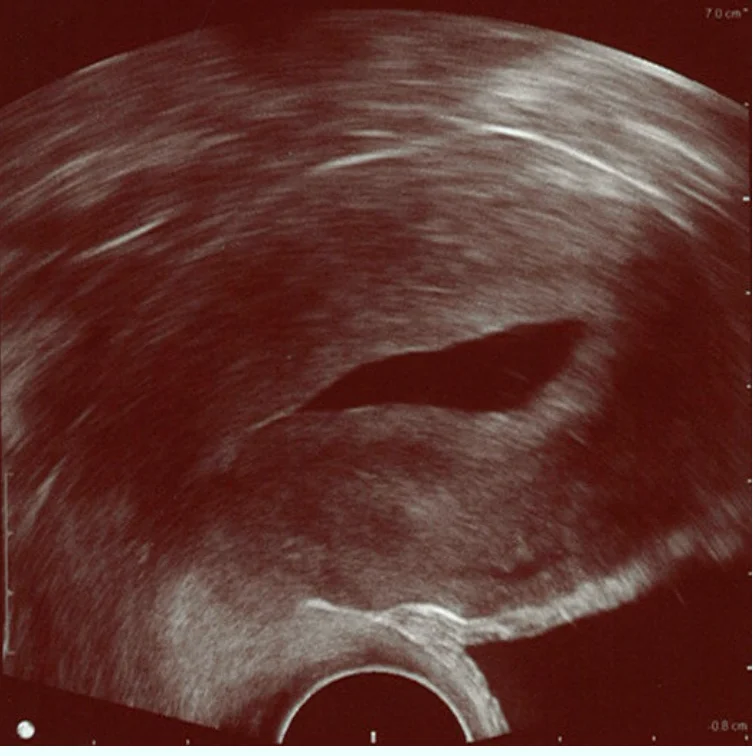 SIS ultrasound