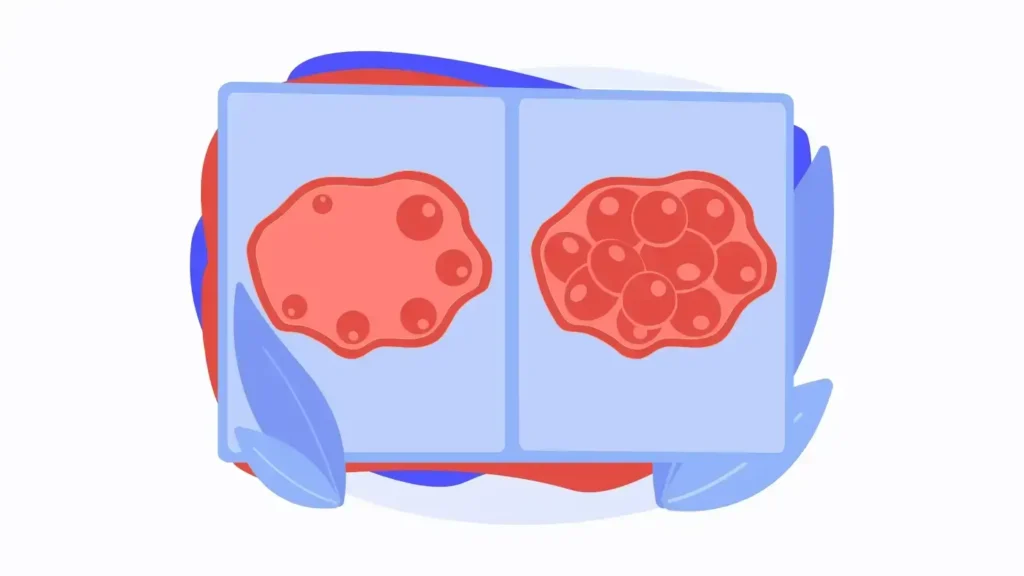 Ovarian Hyperstimulation Syndrome (OHSS)